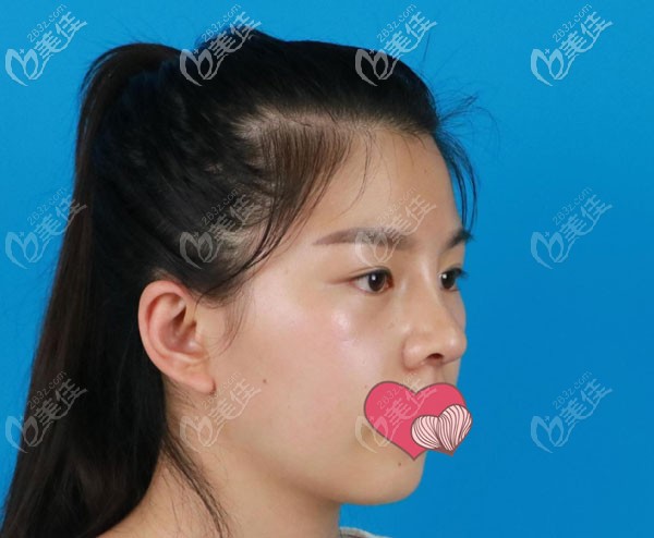 半肋骨鼻综合15天弧度很自然