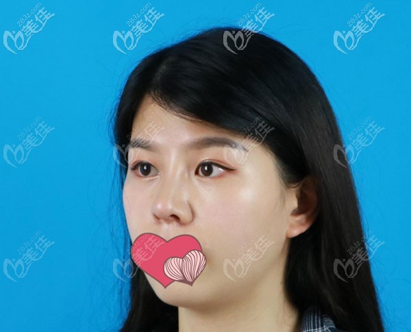 肋软骨隆鼻一个月鼻小柱位置有点红