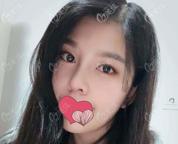 隆鼻术后40天鼻头已经有触感