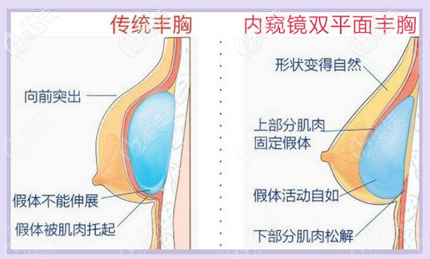 梅州曙光内窥镜双平面隆胸技术优势 梅州曙光内窥镜双平面隆胸技术优势