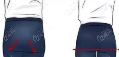 做提臀线术前术后对比照