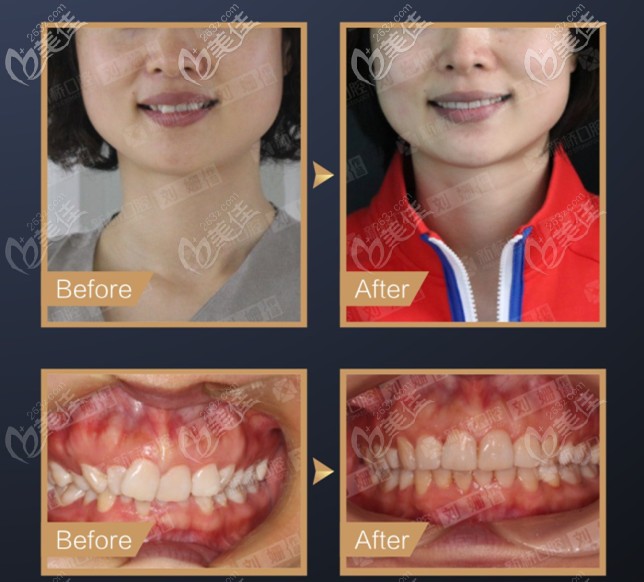 在成都新桥口腔戴隐形牙套矫正深覆颌的价格是多少?附效果图