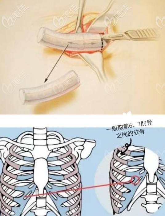 武汉艺星肋软骨隆鼻236z.com