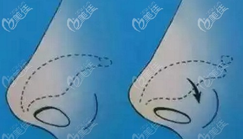 轻度鼻翼缘后缩该如何修复