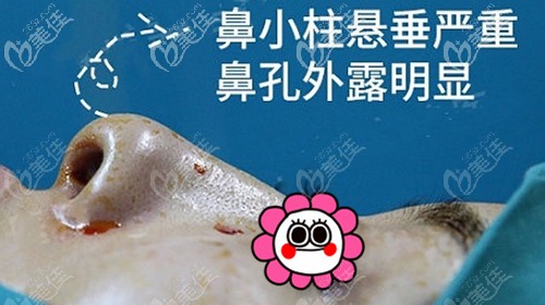 鼻翼缘退缩后出现的问题