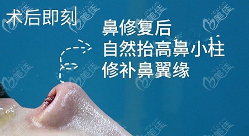 鼻翼缘后缩修复后的效果