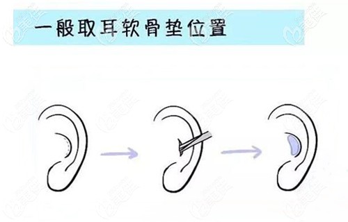 耳后筋膜隆鼻和耳软骨的区别