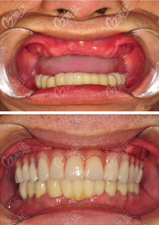 罗幼刚种植牙案例