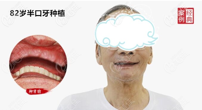 82岁老人,上半口牙缺失,做的allon4半口种植牙 82岁老人,上半口牙缺失,做的allon4半口种植牙