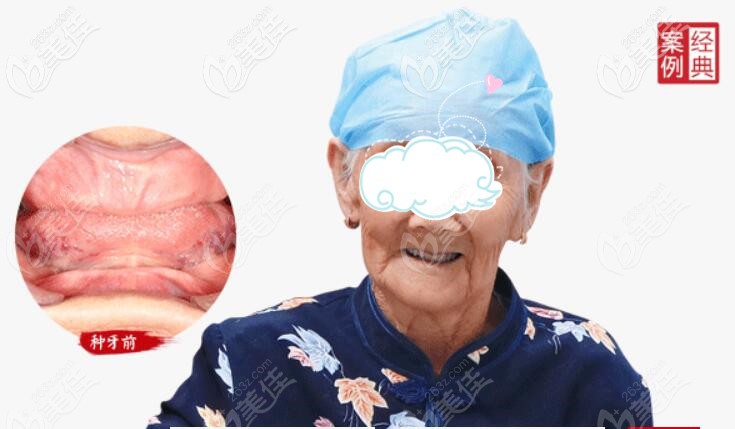 广大口腔全口种植牙<span style=