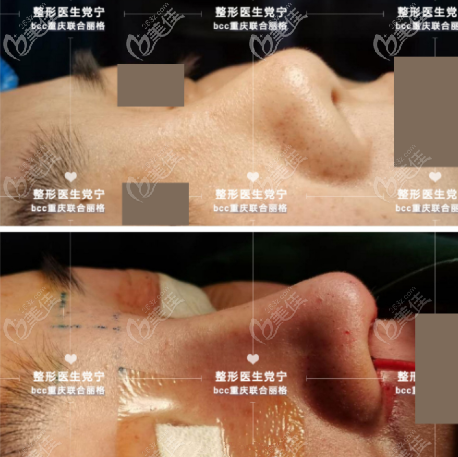 重庆联合丽格党宁技术怎么样？眼综合和肋骨鼻综合案例你都得看！
