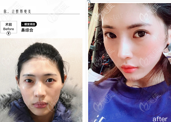 西安艺星做韩士生科一段假体隆鼻<span style=