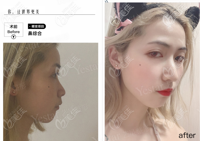 西安艺星做韩士生科一段假体隆鼻<span style=