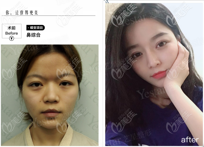 西安艺星做韩士生科一段假体隆鼻<span style=