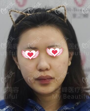 隆鼻术前照 隆鼻术前照