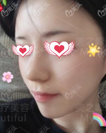 鼻综合术后一周照 鼻综合术后一周照