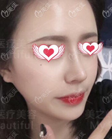 鼻综合术后15天效果照 鼻综合术后15天效果照