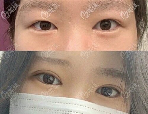 高振欣双眼皮案例