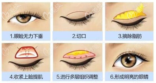 全切双眼皮加提肌手术全过程