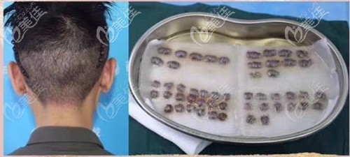 确定手术，提取后枕部毛囊