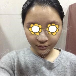 刚做完埋线提升和隆鼻术后的脸