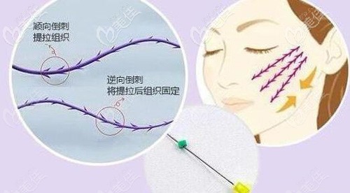 用埋线提升改善皮肤下垂的原理
