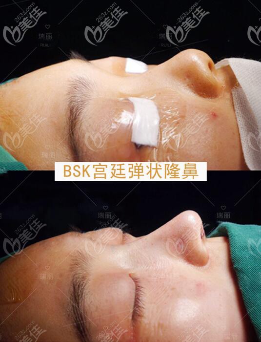 吴昌炎肋骨鼻对比效果图