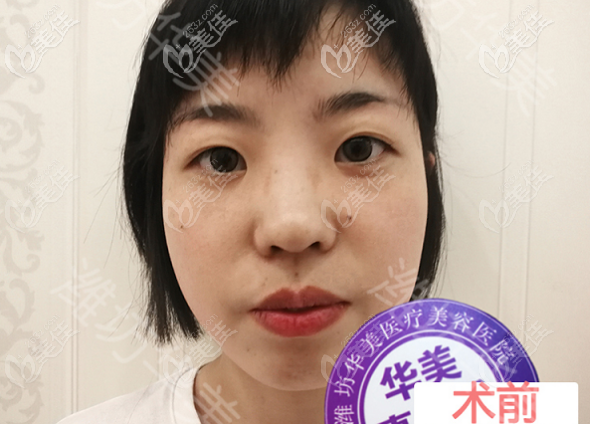 潍坊华美做埋线双眼皮术前照片 潍坊华美做埋线双眼皮术前照片