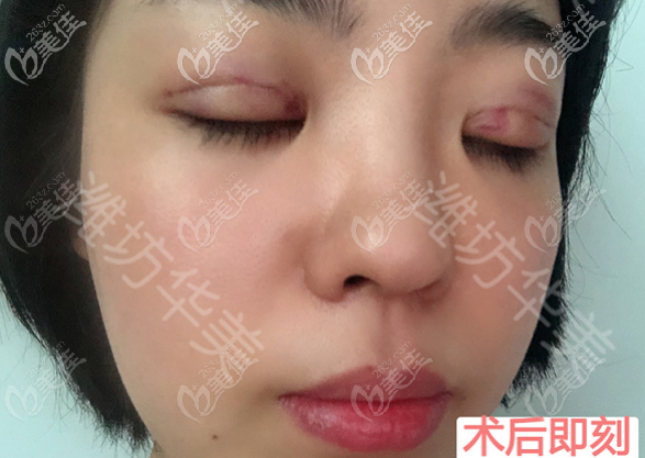 潍坊华美做埋线双眼皮术后即刻照片 潍坊华美做埋线双眼皮术后即刻照片
