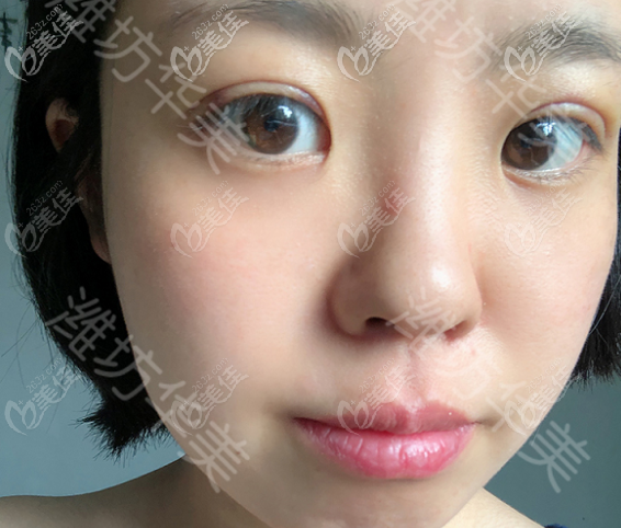 潍坊华美做埋线双眼皮术后半个月的样子 潍坊华美做埋线双眼皮术后半个月的样子