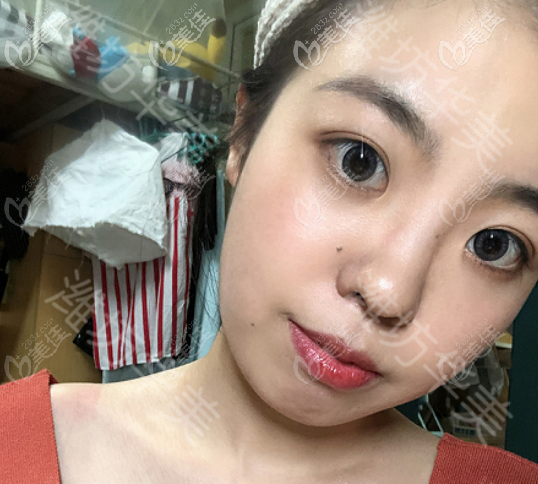 潍坊华美做埋线双眼皮术后一个月的样子 潍坊华美做埋线双眼皮术后一个月的样子