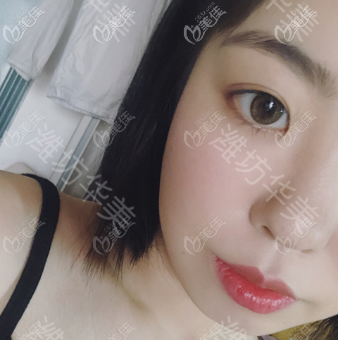 潍坊华美做埋线双眼皮术后三个月的样子 潍坊华美做埋线双眼皮术后三个月的样子