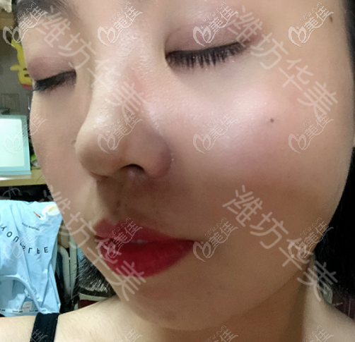 潍坊华美创和做埋线双眼皮厉害，请参考真人日记