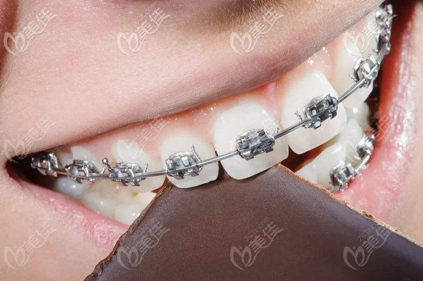 金属托槽矫正 金属托槽矫正
