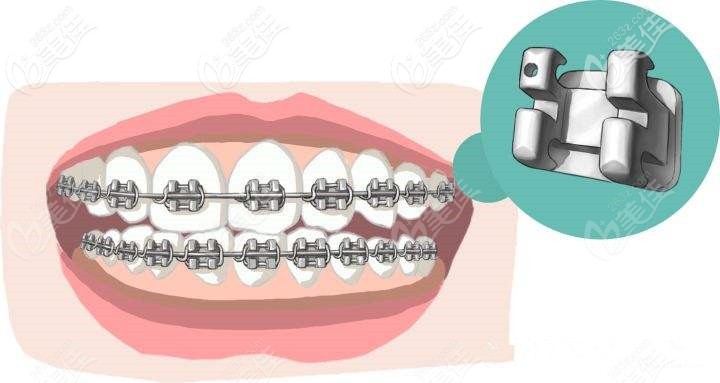 自锁牙套的锁扣 自锁牙套的锁扣