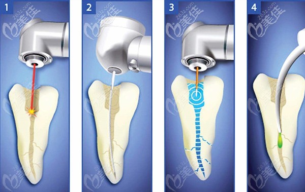 根管治疗步骤及过程图