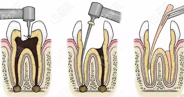 南京做一次性根管治疗的费用