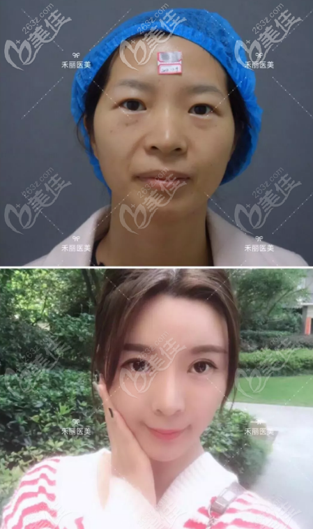 不得不说广州禾丽医美鼻子和脂肪填充技术真的很厉害