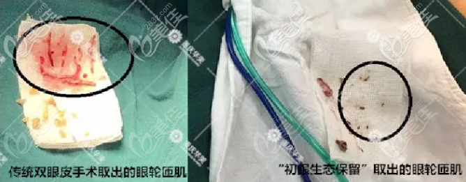 初眼生态保留术和传统双眼皮术的区别 初眼生态保留术和传统双眼皮术的区别