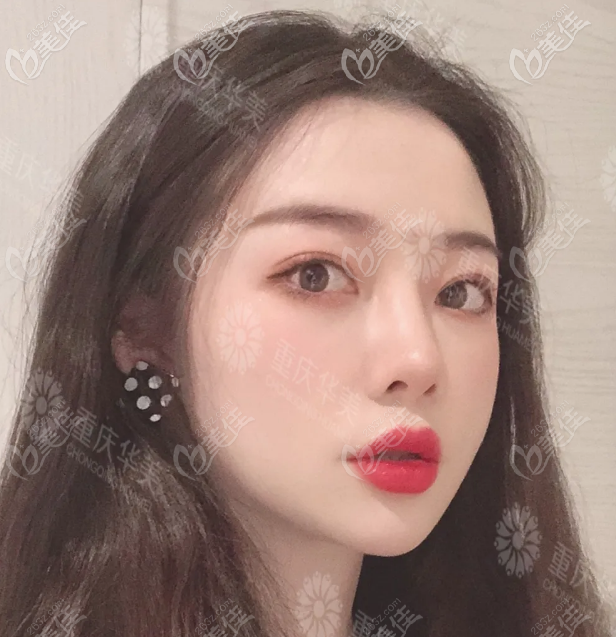 重庆华美双眼皮宽改窄案例图片 重庆华美双眼皮宽改窄案例图片
