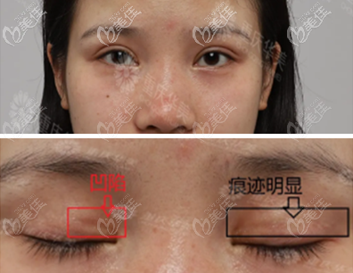 术前割的过深 术前割的过深