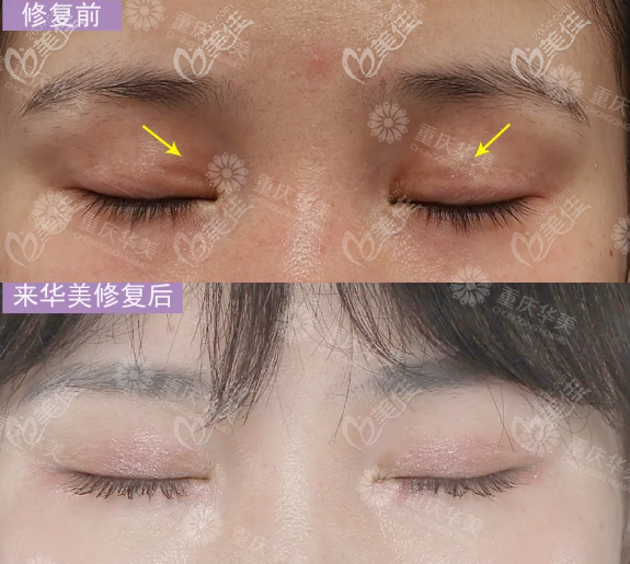 闭眼无痕 闭眼无痕