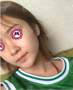 我做耳软骨复合隆鼻前 我做耳软骨复合隆鼻前