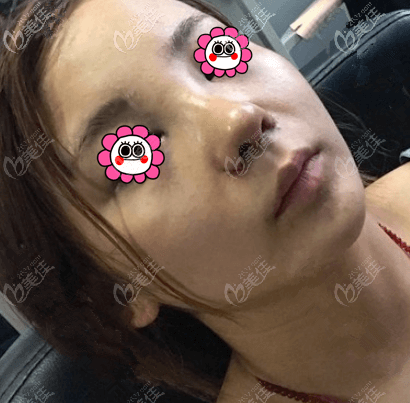 做耳软骨复合隆鼻有2天了 做耳软骨复合隆鼻有2天了