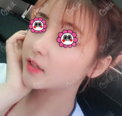 宫国华做鼻子怎么样?从我做耳软骨复合隆鼻效果了解 宫国华做鼻子怎么样?从我做耳软骨复合隆鼻效果了解