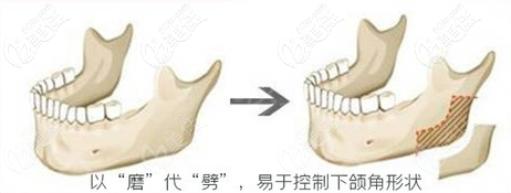 下颌角形状更自然 下颌角形状更自然