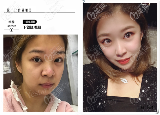 水动力3.0面部吸脂<span style= 水动力3.0面部吸脂<span style=