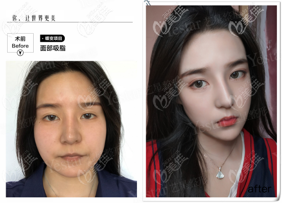 水动力3.0面部吸脂<span style= 水动力3.0面部吸脂<span style=