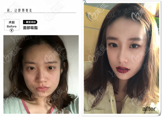 西安哪里做水动力面部吸脂好？原来西安艺星做水动力吸脂挺自然的