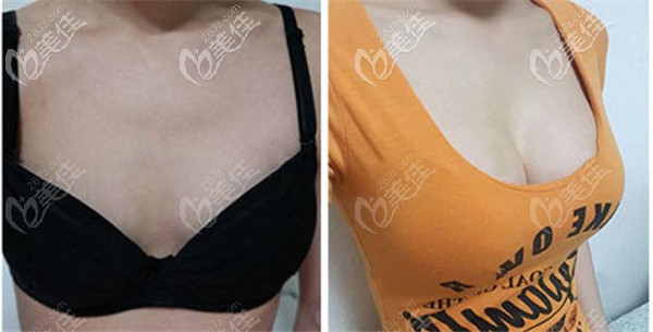 易东风医生做脂肪丰胸的术前术后对比